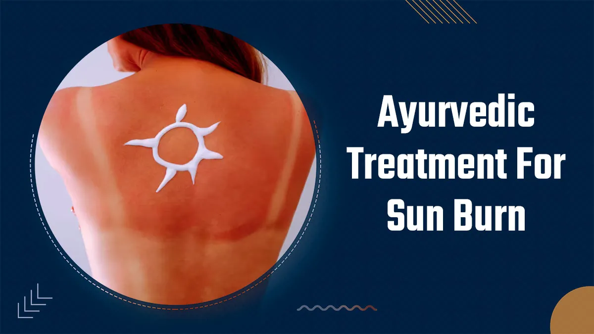 Got Sunburn? Try This Ayurvedic Treatment with Ghrit Kumari (Aloe Vera) for Instant Relief
