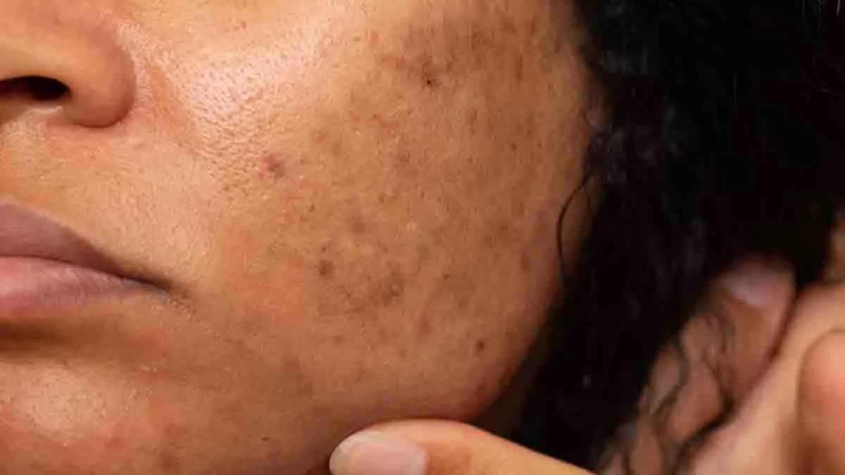 Melasma On Cheeks: Is Sun Exposure To Blame?