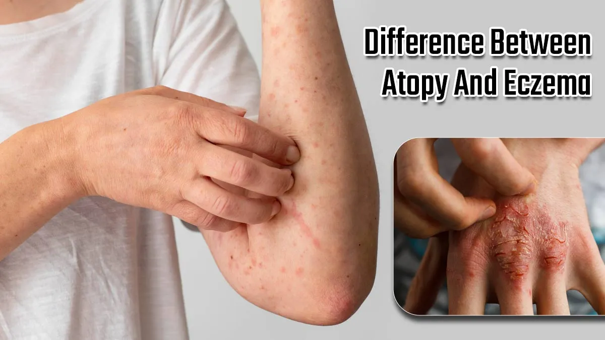 Is Atopy And Eczema The Same? Expert Shares The Difference Between The Skin Issues