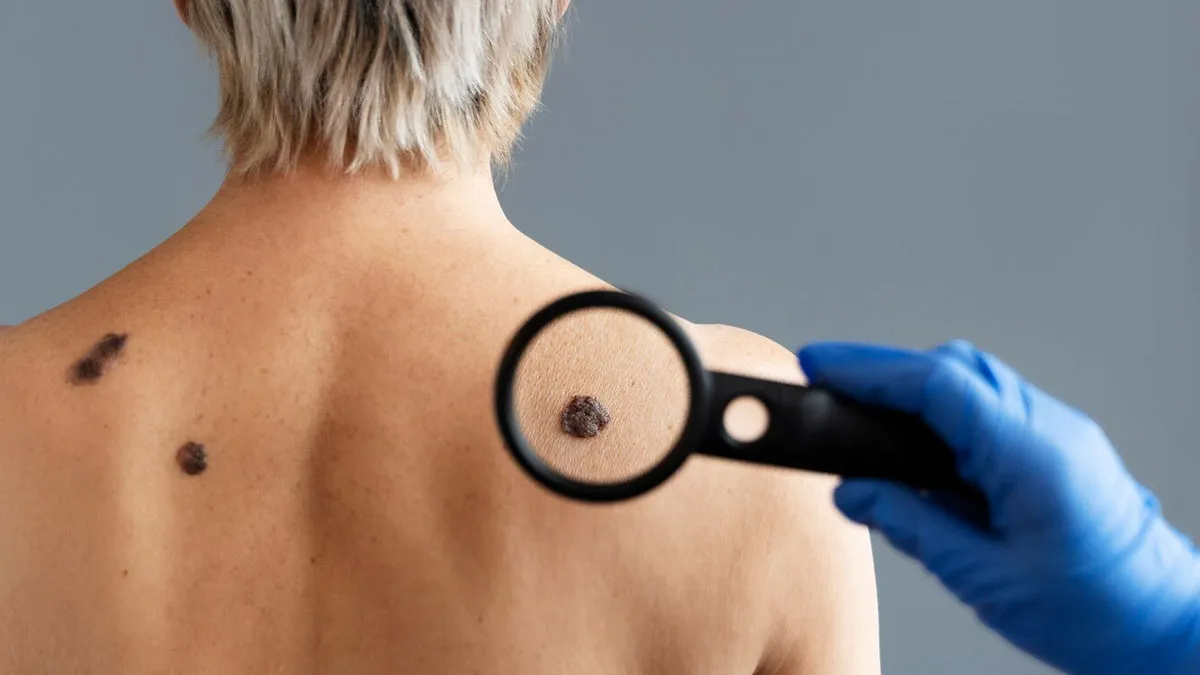 Can Having More Moles Increase Your Skin Cancer Risk?