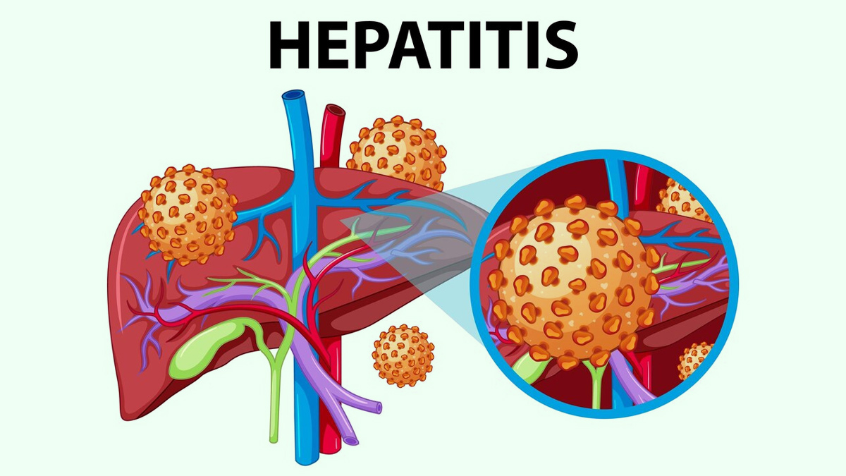 hepatitis