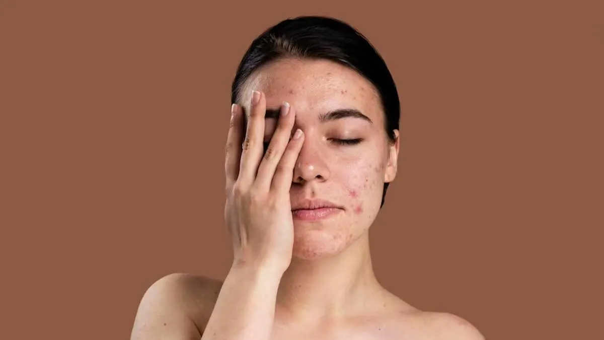 Causes Of Acne In Women You Should Know For Better Management