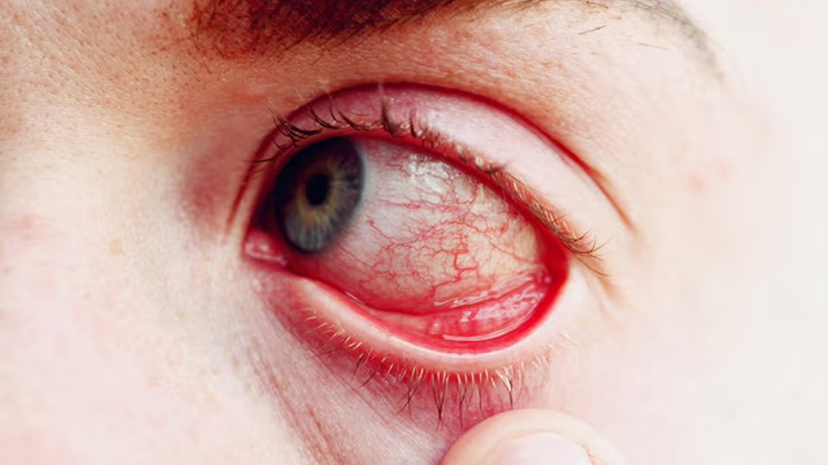 Conjunctivitis