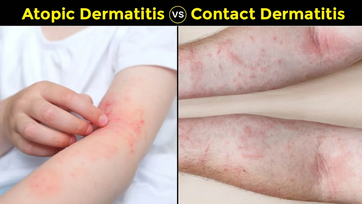 Atopic Dermatitis Vs Contact Dermatitis: Expert Explains How To Differentiate Between The Two