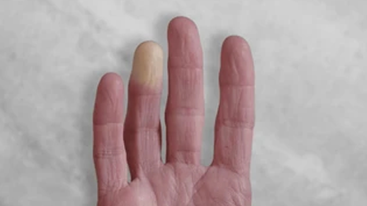 Raynaud's-Disease