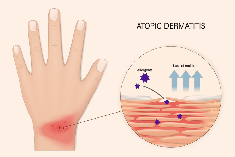 atopic-dermatitis