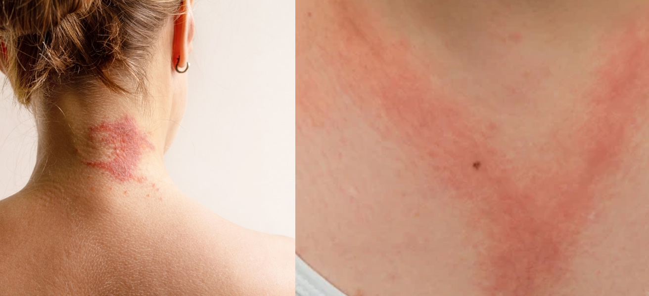 atopic-vs-contact-dermatitis