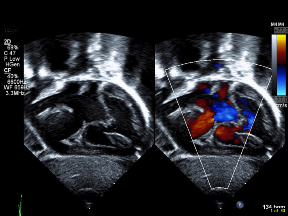 Ventricular-septal-defect
