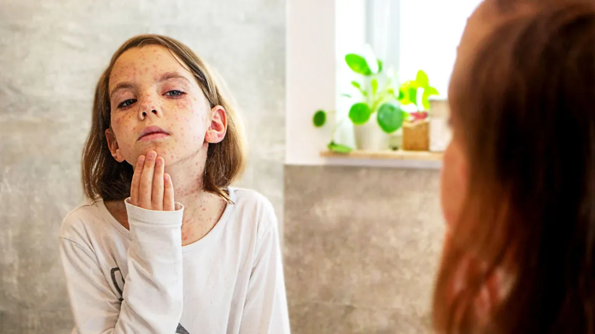 Second Child Dies Amid Measles Outbreak In Texas As Cases Near 500 | Here's What You Should Know!