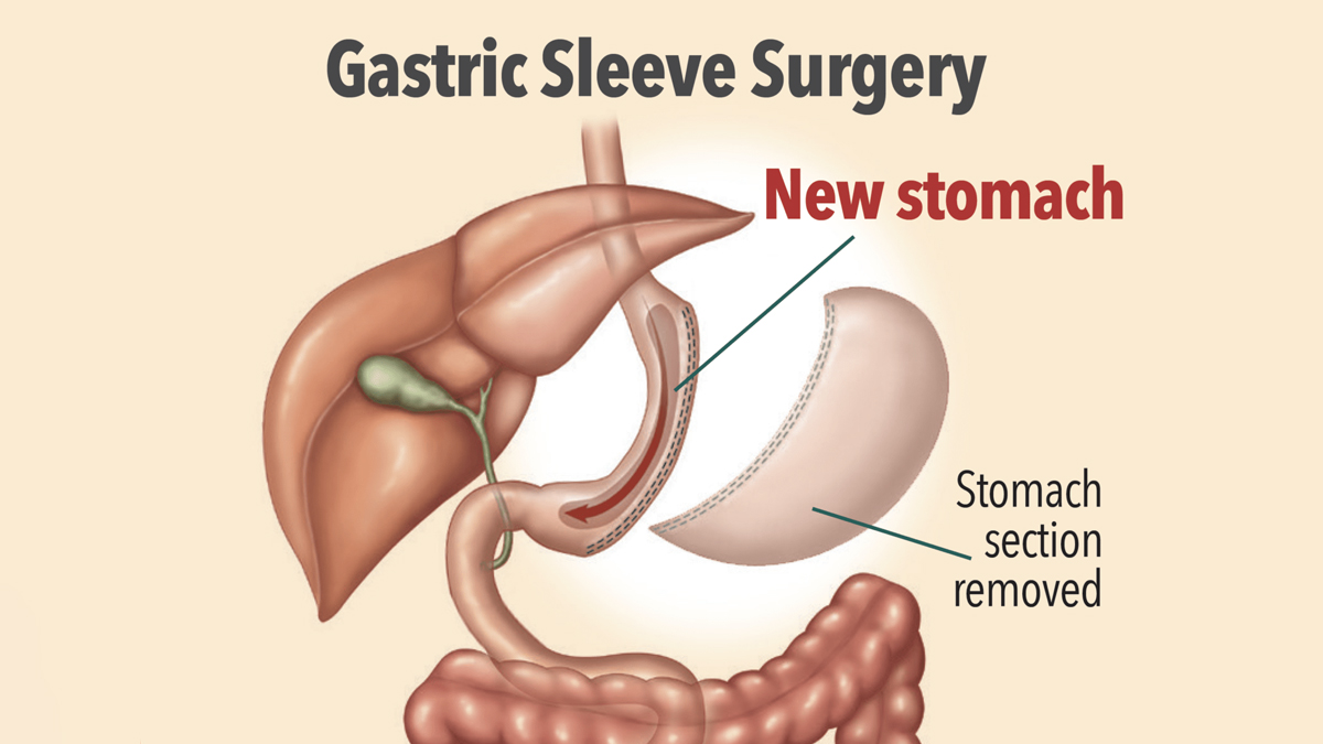 3-weight-loss-surgery