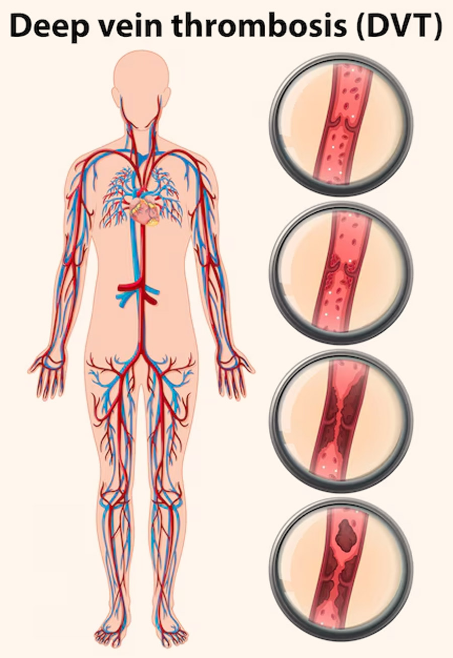Deep-Vein-Thrombosis