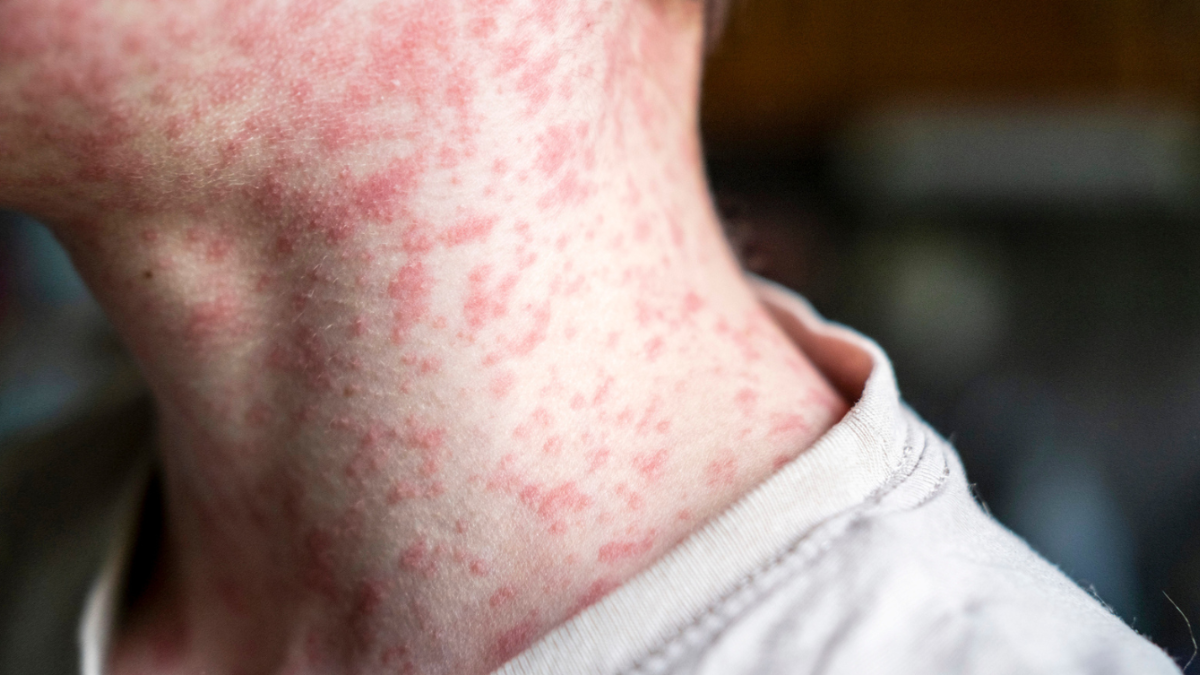 Deadly Measles Outbreak Sweeps Across US: Texas At Epicentre With 500+ Cases And 2 Deaths