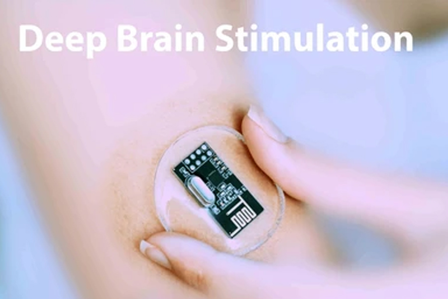 deep-brain-stimulation
