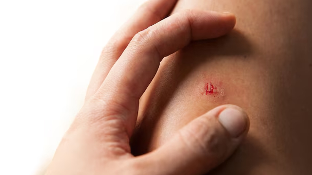 mircrobleeding-in-body