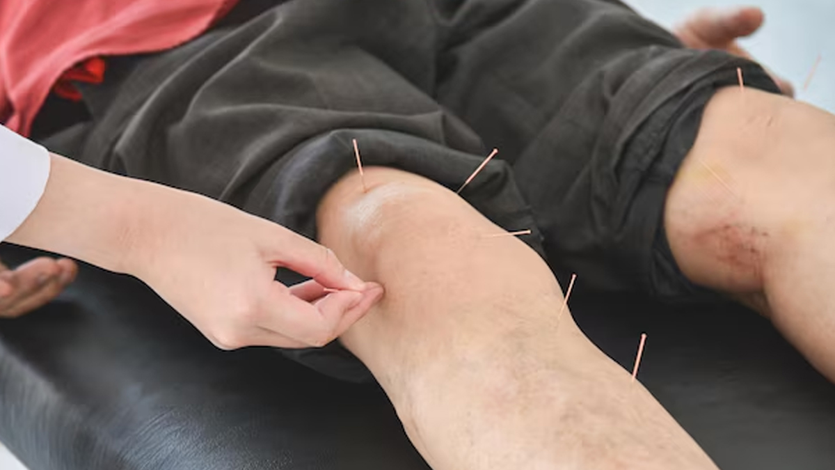 acupuncture-for-RLS