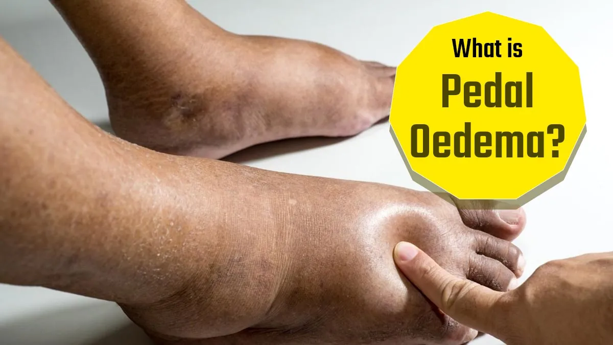 What is Pedal Oedema? Causes, Symptoms, and Is It Dangerous