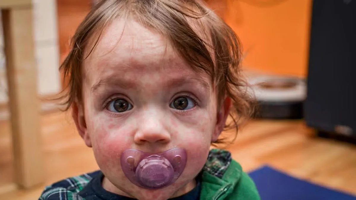 Vaccinated But Still Got Measles? Understanding How It Can Happen
