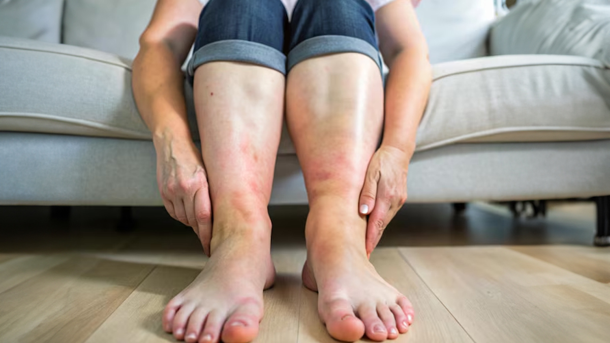 pedal Oedema 2 - 2025-04-16T131027.957