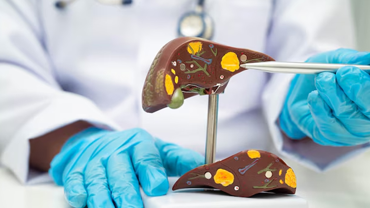 fatty-liver-disease