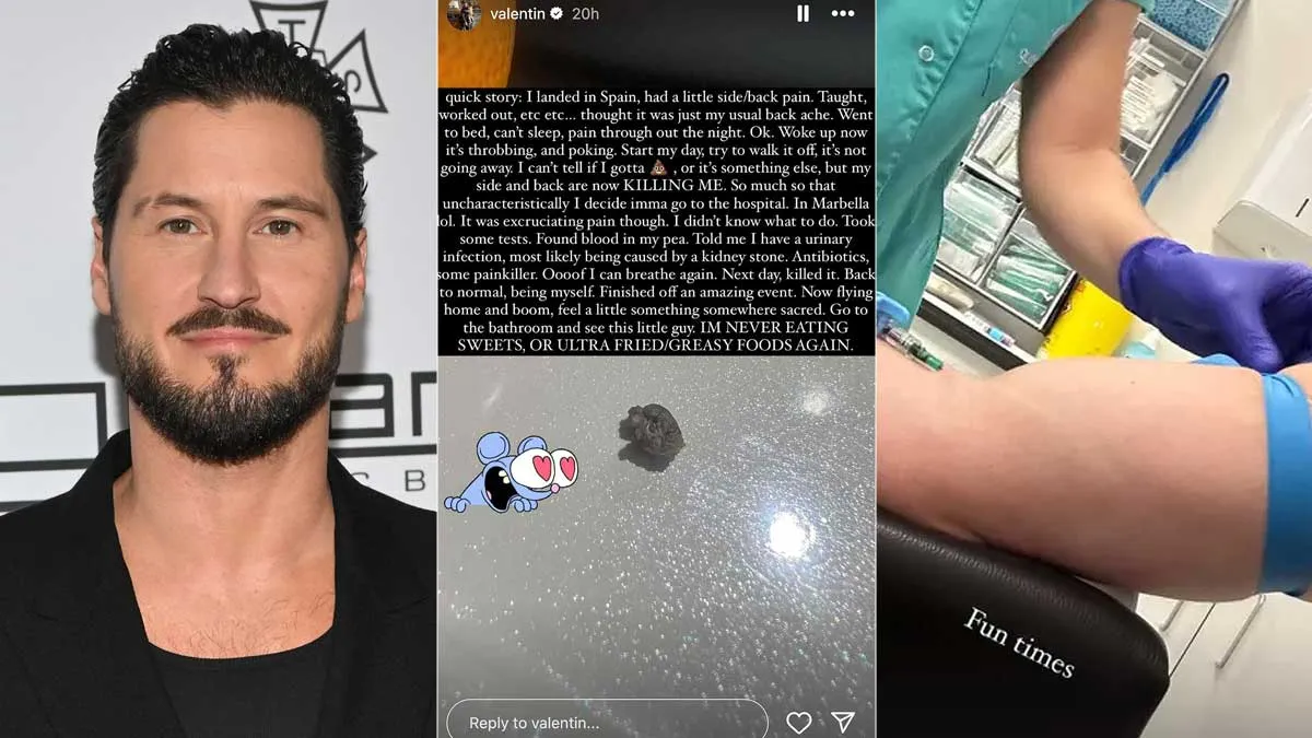 Val Chmerkovskiy Shares His Experience, Passes Kidney Stone on A Plane: Is It Medically Possible?