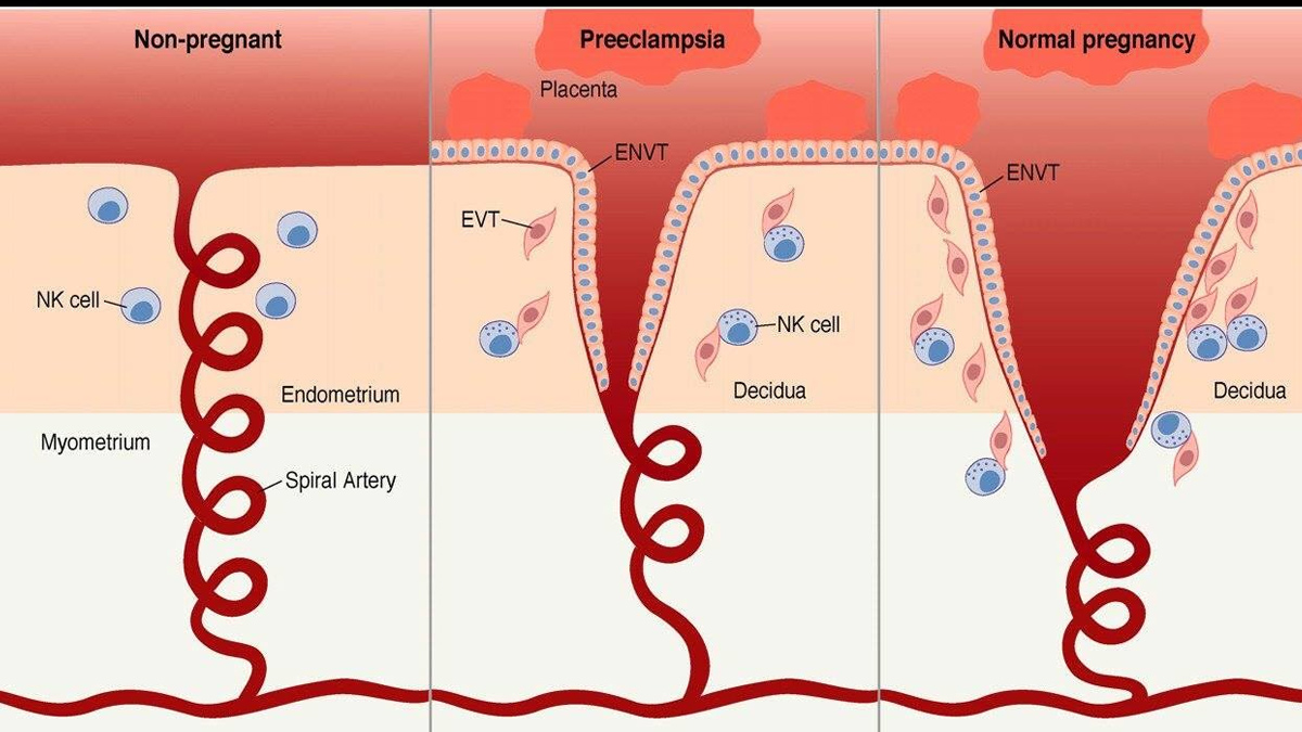 2-preeclampsia