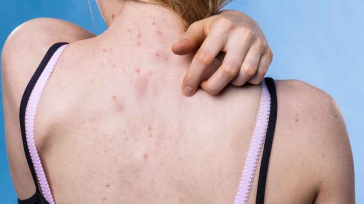 Let’s Talk About Bacne, Boob Sweat And Ingrowns: The Body Care Guide Nobody Gave You