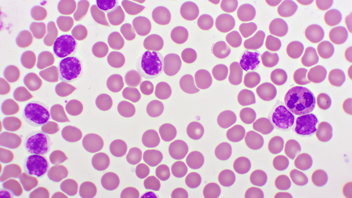 Lymphoma and CLL 2 - 2025-04-30T113448.024