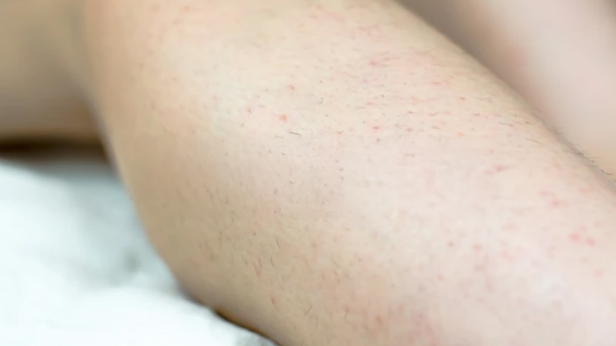 ingrown-hair