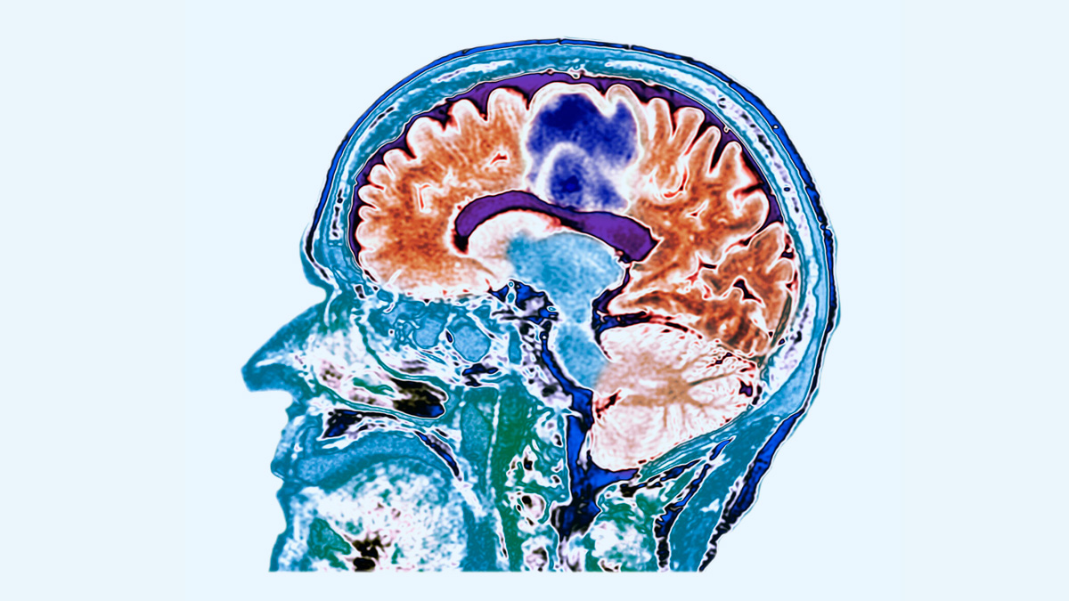 Glioblastoma cancer 1 - 2025-05-01T124930.152