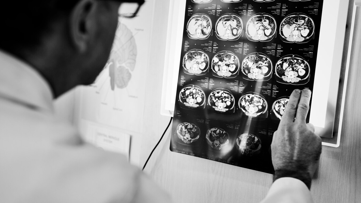 Glioblastoma deadly cancer 3 - 2025-05-01T124940.084