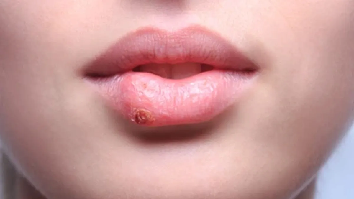 Summer Care: Home Remedies For Treating Sunburn Blisters On Lips