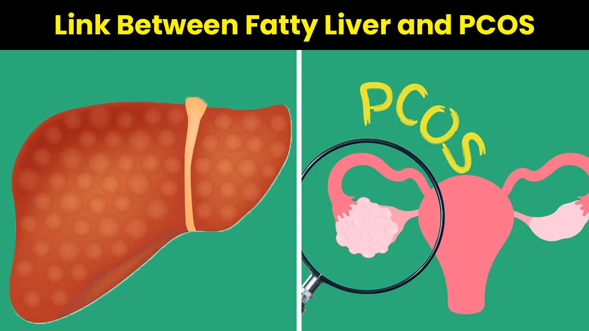 Fatty Liver And PCOS: The Hidden Hormonal And Metabolic Link That You Should Know