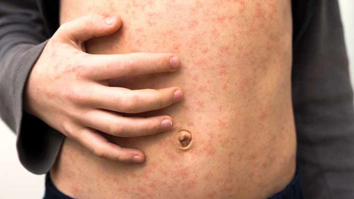 Measles Cases Surge To 683 In Texas, Health Officials Sound Alarm