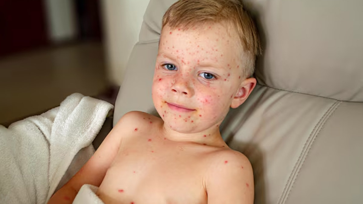 How To Recognise Measles Rash: Signs And Key Characteristics