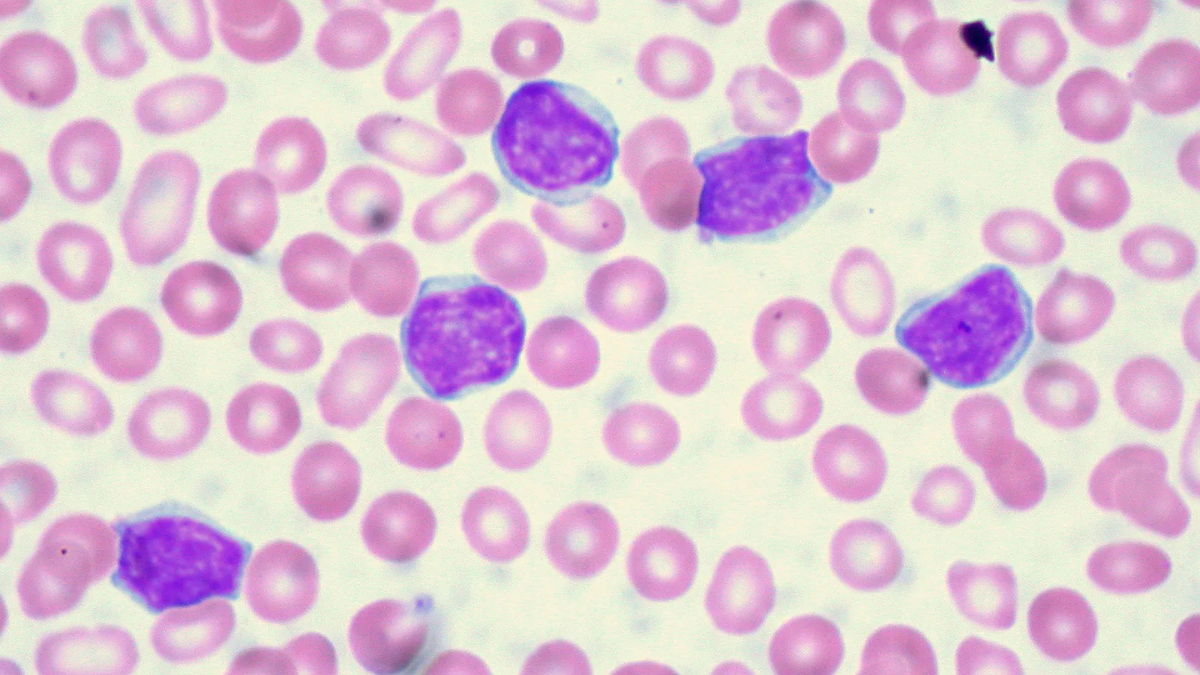 02-leukemia