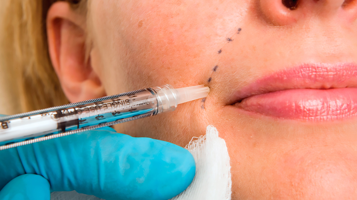 khloe kardashian face fillers 3 - 2025-05-06T123222.071