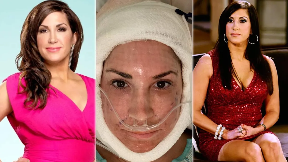 RHONJ Alum Jacqueline Laurita Reveals Facelift and Neck Lift Surgery With Video: “Still Numb on One Side”