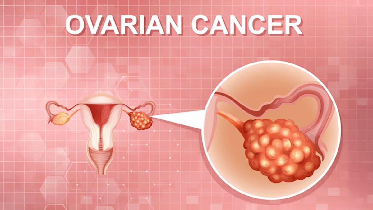 ovarian-cancer