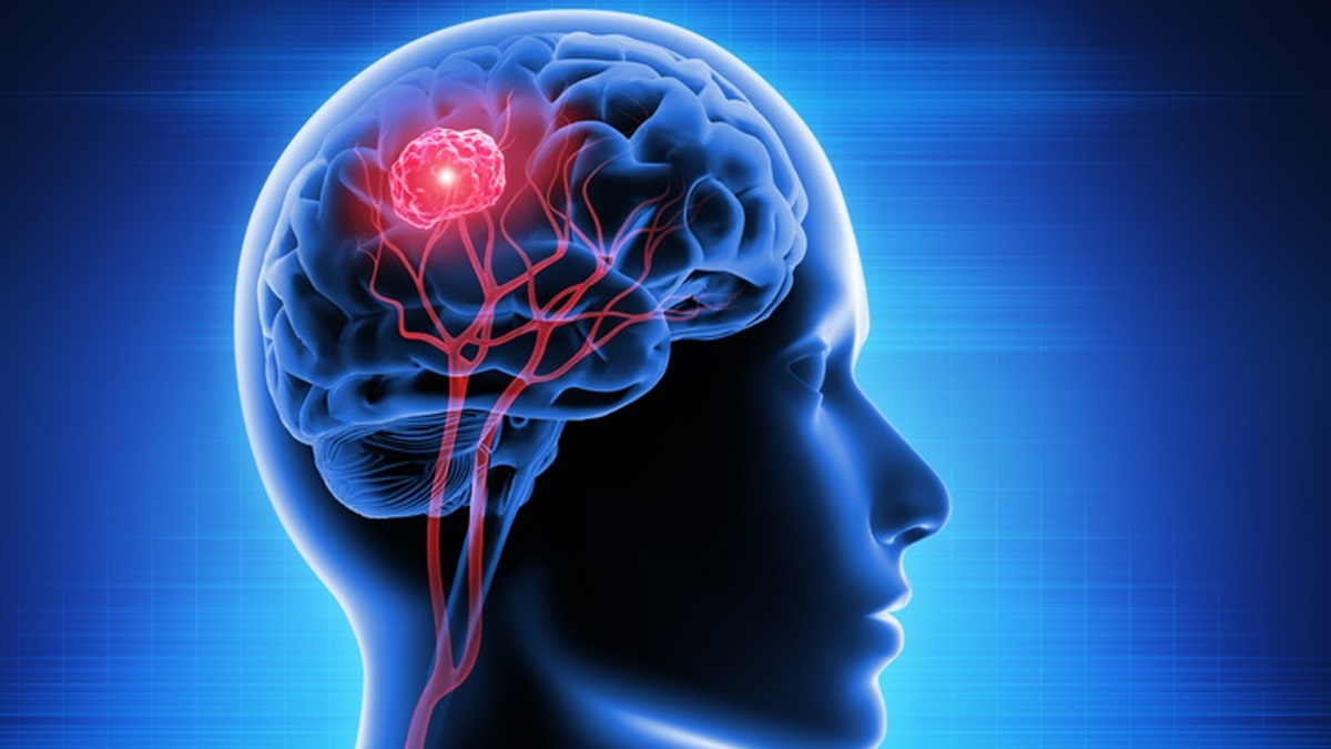 brain cancer 2 - 2025-05-09T105722.751