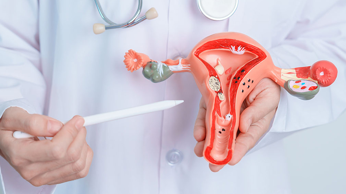 Endometriosis lead to cancer 2 - 2025-05-13T133745.902