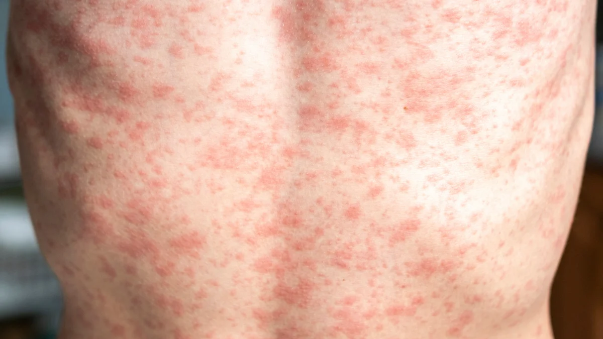 Texas Confirms First Measles Case In Dallas Amid Ongoing Outbreak