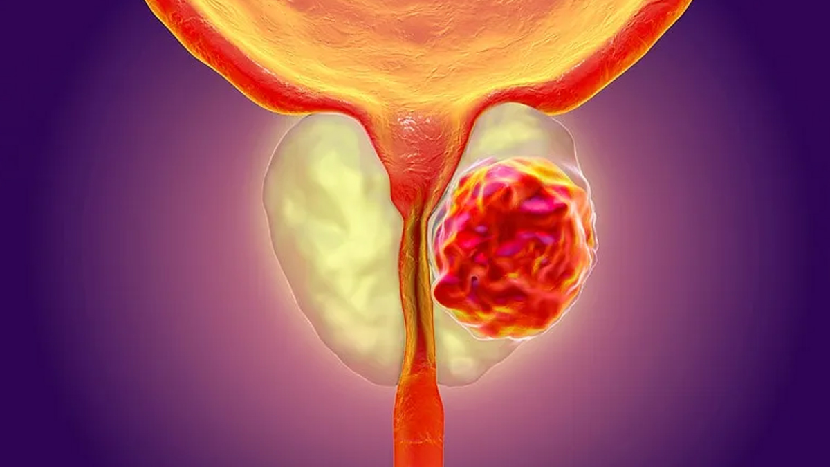 prostate cancer 3 - 2025-05-14T112506.734