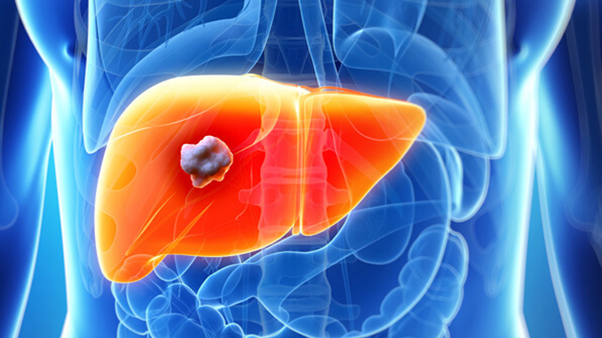 liver tumour 1 - 2025-05-16T112715.337