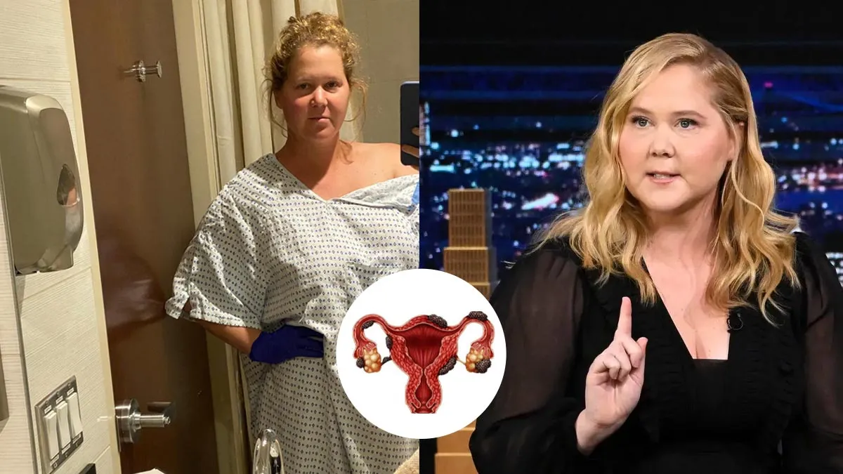 What Are Chocolate Cysts? How Amy Schumer Overcame Endometriosis and Achieved Pregnancy