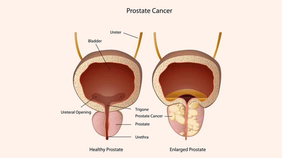 prostate cancer 1 - 2025-05-14T112509.599
