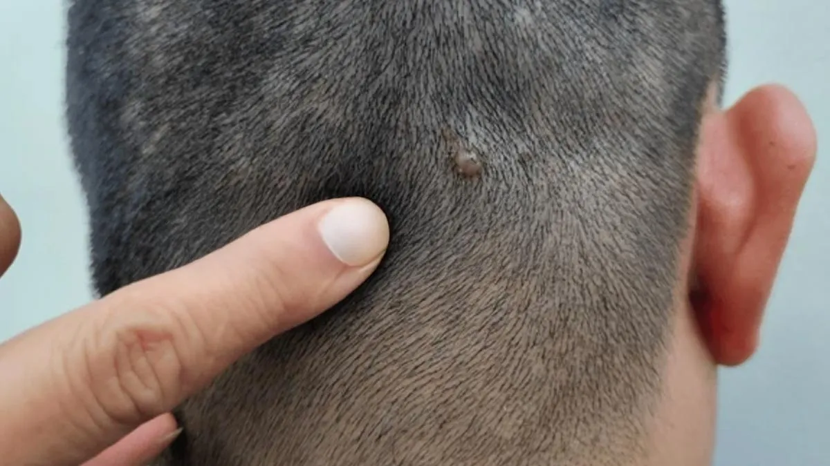Scalp Zits In Humid Weather: What Causes Them And How To Fix It