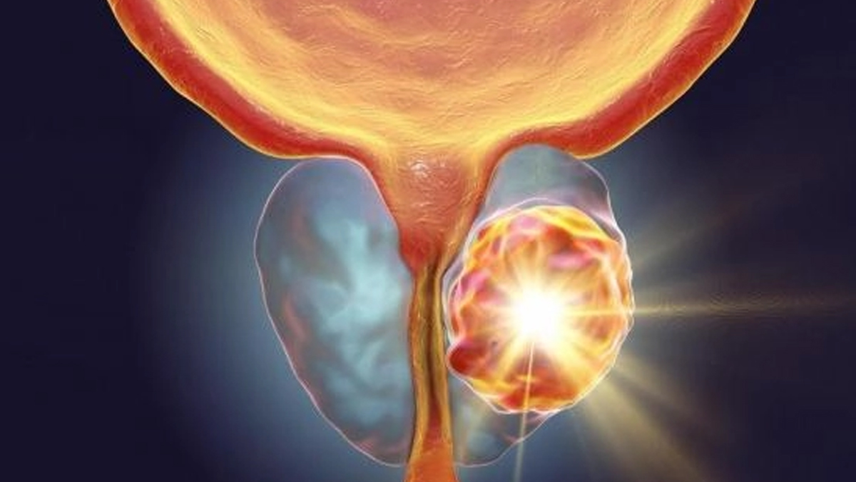 protate cancer 2 - 2025-05-20T103108.600