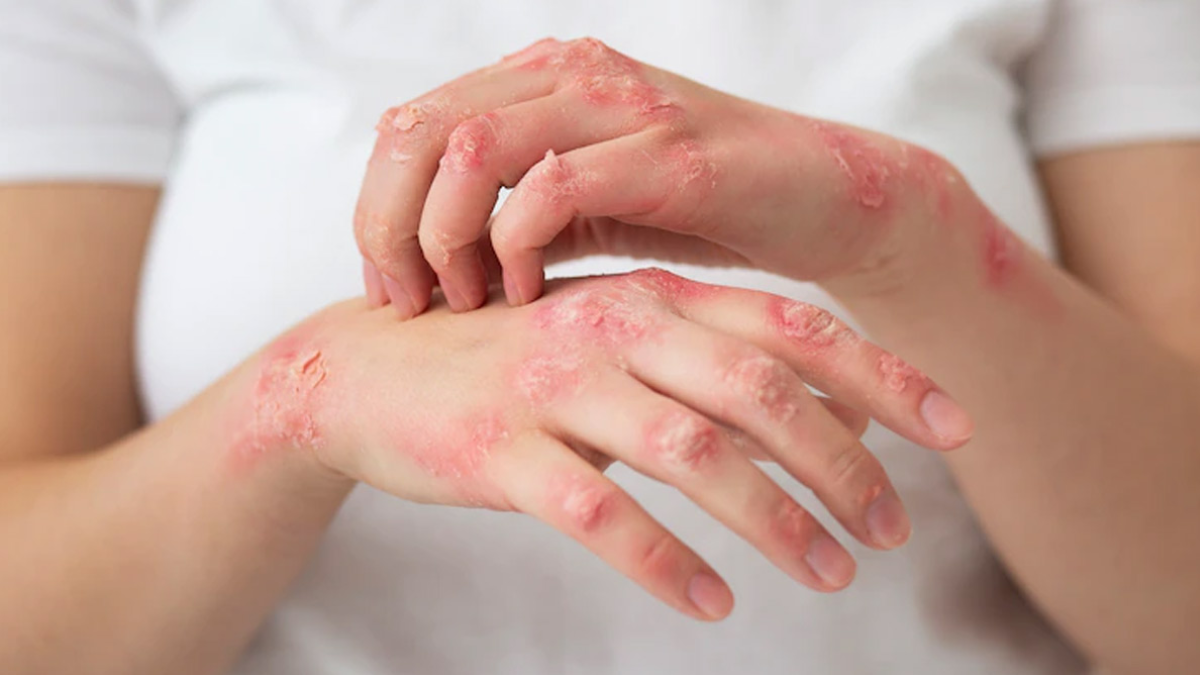 Psoriasis Linked To Obesity And Fatty Liver Risk, New Study Reveals Why