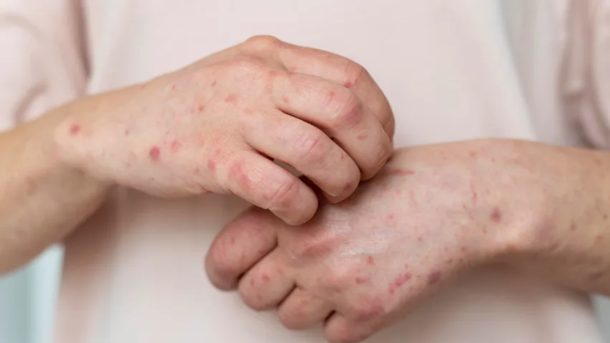 Valley Fever Outbreak In The US: Know Symptoms, Causes & Treatment