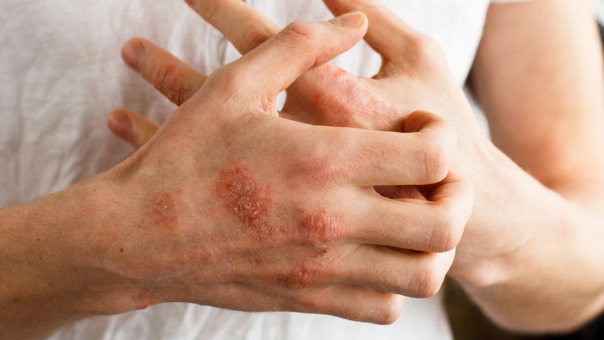 01-psoriasis
